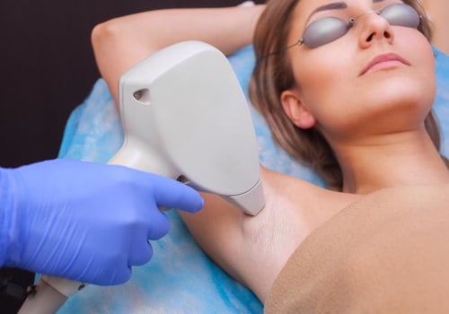 What is laser hair removal?